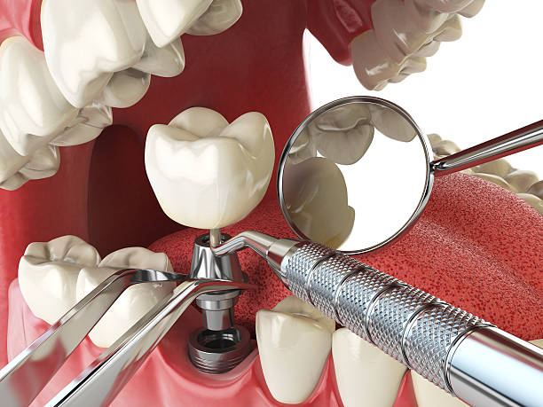 Best Emergency Dentist for Knocked-Out Tooth in Burlington, IA